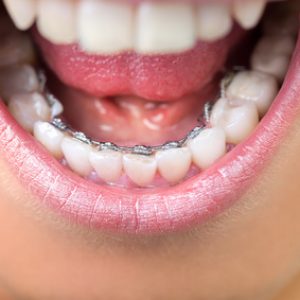 Young woman showing lingual braces, close up